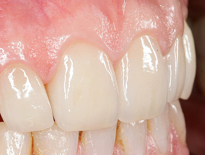 Die Zahnfleischpapillen füllen den Zahnzwischenraum aus.