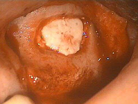 Eingesetztes Implantat