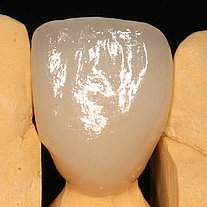 Keramikimplantate im Frontzahnbereich
