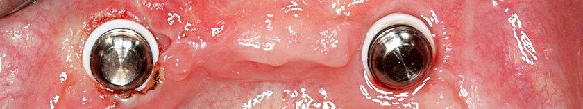 All-on-2 (Zwei Implantate)