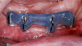 All-on-4 (4 Implantate)