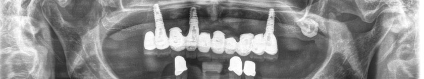 Röntgenaufnahme: Parodontitis und Periimplantitis in einem Mund zusammen auftretend- massiver Knochenabbau an natürlichen Zähnen und den Implantaten