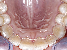 Invisalign in situ