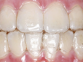 Invisalign in situ