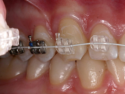 Keramikbrackets und weiße Bögen