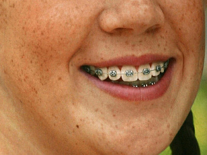 Metall- und Keramikbrackets: