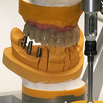 Titanimplantate im Seitenzahnbereich