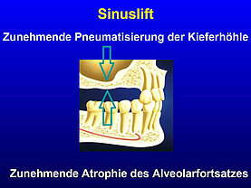 Sinuslift