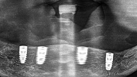 All-on-4 im Röntgenbild