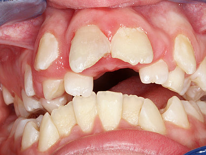 Zahnstatus vor Kieferorthopädie