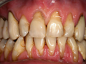 Zahnfleischrückzug