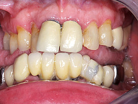 Schlechte Kronenrandepassform der oberen mittleren Schneidezähne, fehlende Farbabstimmung mit den Restzähnen, Bruch im vorderen Bereich im Unterkiefer rechts.