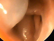 Ein Polyp beeinträchtigt die Lüftung der Kieferhöhle zur Nasenhöhle (Bild 1)