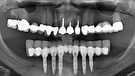 All-on-6. Aus Kostengründen war es der Wunsch des Patienten primär und zeitnah den Unterkiefer mit festem Zahnersatz zu versorgen. Über den Behandlungsbedarf im Oberkiefer wurde der Patient ausdrücklich aufgeklärt.