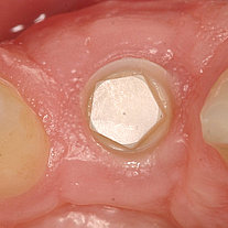 Keramikimplantate im Frontzahnbereich