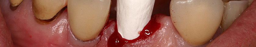 Auffüllung des Zahnfachs mit Collagenkegel