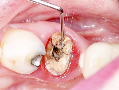 Irreversible Schädigung der Zahnwurzel.