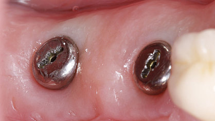 Implantate in der Einheilphase für das Weichgewebe