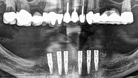 All-on-6. Aus Kostengründen war es der Wunsch des Patienten primär und zeitnah den Unterkiefer mit festem Zahnersatz zu versorgen. Über den Behandlungsbedarf im Oberkiefer wurde der Patient ausdrücklich aufgeklärt.