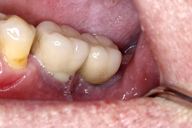 Stark erhöhte COVID 19- Erkrankungsgefahr bei Patienten mit unbehandelter Parodontitis oder Periimplantitis