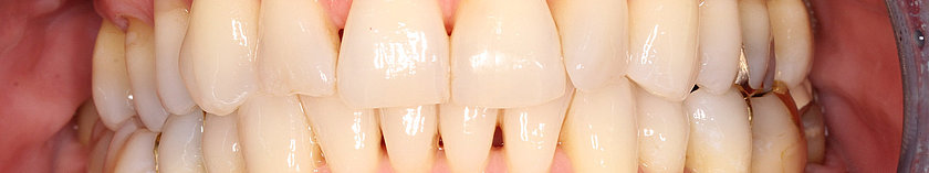 Bei weiterem Knochenabbau und fortschreitendem Zahnfleischrückzug werden die Dreiecke größer.