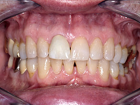 Einzelkrone am mittleren Schneidezahn im Mund rechts: Überstehender Kronenrand, fehlende Form und Farbabstimmung mit den natürlichen Zähnen, deswegen opaque Transluzenz und leichte Identifikation als Zahnersatz.