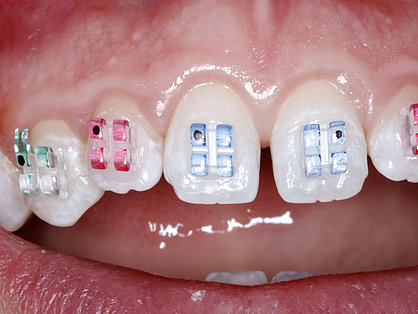 Bunte Brackets