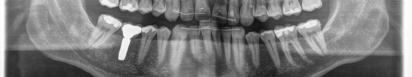 Keramikimplantat zum Ersatz eines Backenzahnes im Unterkiefer rechts