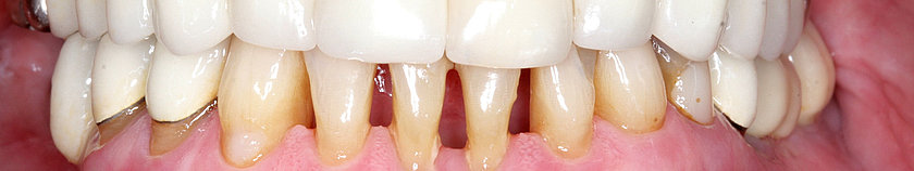 Bei unbehandelter oder nicht ausreichend behandelter Parodontitis verschlimmert sich das kosmetische Erscheinungsbild immer weiter. Zwischen den Zähnen setzen sich vermehrt Speisereste fest und es entstehen Zischlaute beim Sprechen.