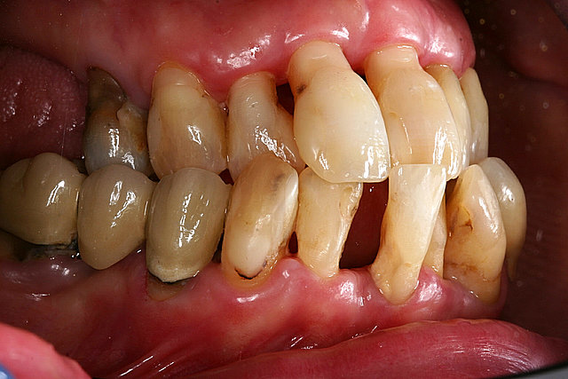  Zahnfehlstellungen / Parodontitis 