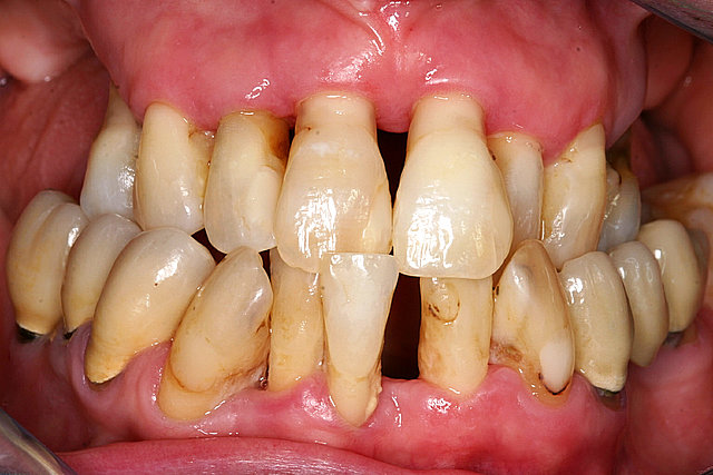  Zahnfehlstellungen / Parodontitis 