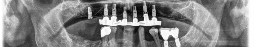 Periimplantitis wegen spaltiger Verbindung zwischen Implantataufbau und Krone