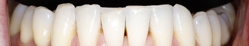Durch Kieferknochenabbau geht das Zahnfleisch zurück - Erste Triangles entstehen.