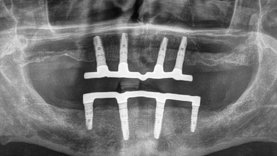 All-on-4 im Röntgenbild
