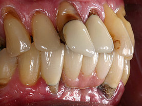 Zahnfleischrückzug